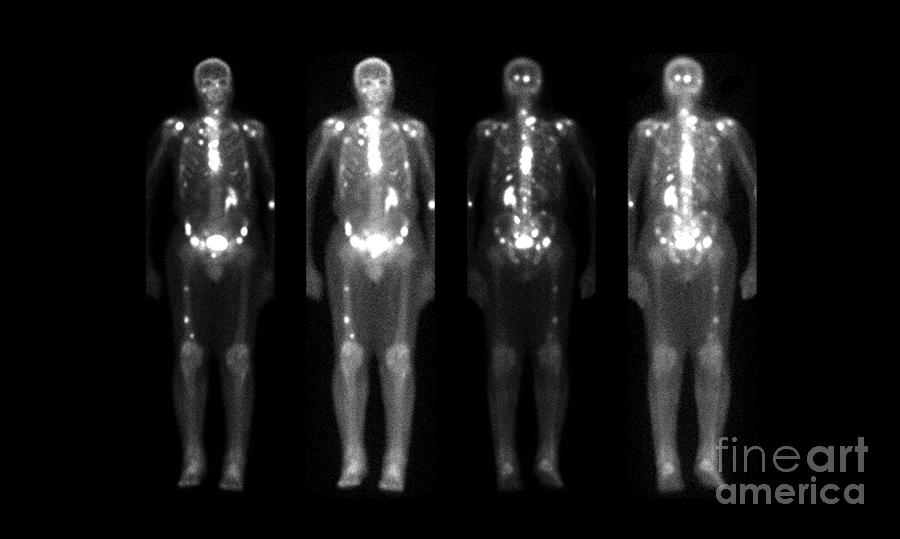 Skeleton Photograph - Nuclear Bone Scans Of Cancer Patients by Medical Body Scans