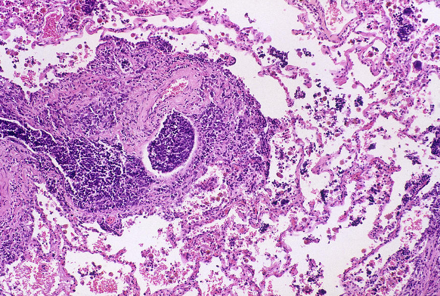 Oat Cell Carcinoma In Human Lung, Lm Photograph by Michael Abbey