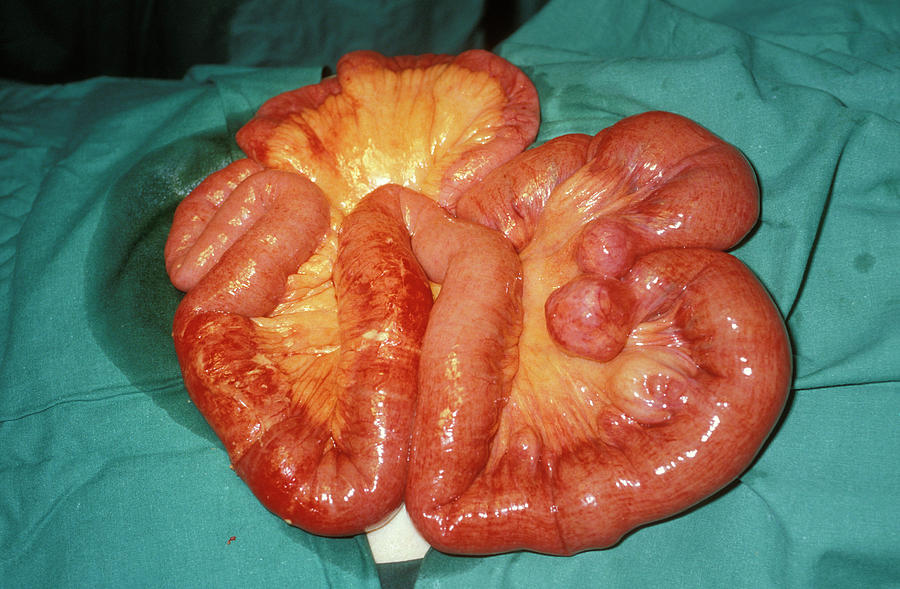 Obstructed Bowel Photograph by Dr M.a. Ansary/science Photo Library