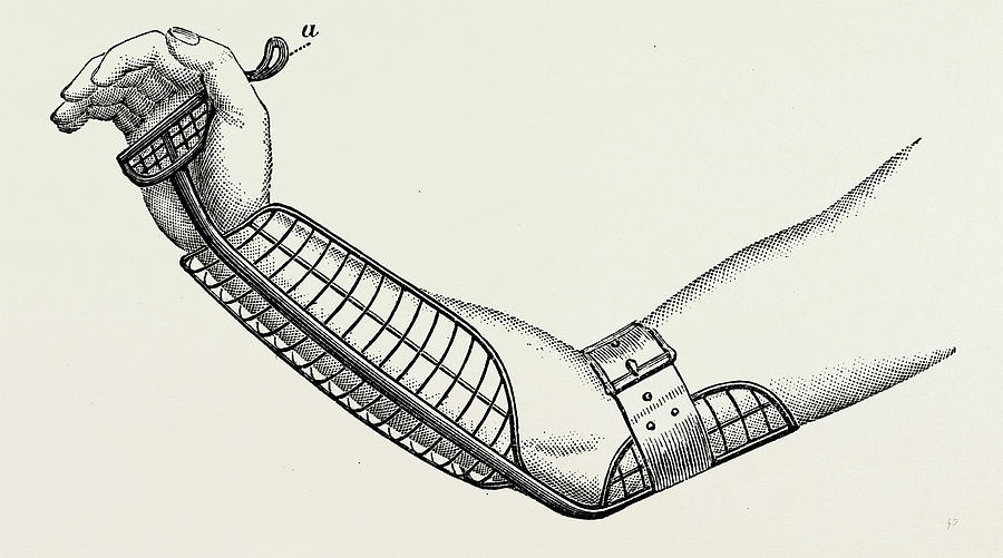 Ollieris Wire Splint For Excision Of The Wrist Drawing by Litz Collection