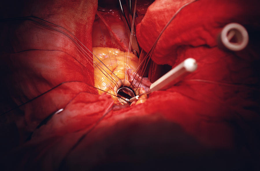 Open-heart Surgery Photograph by John Foxx