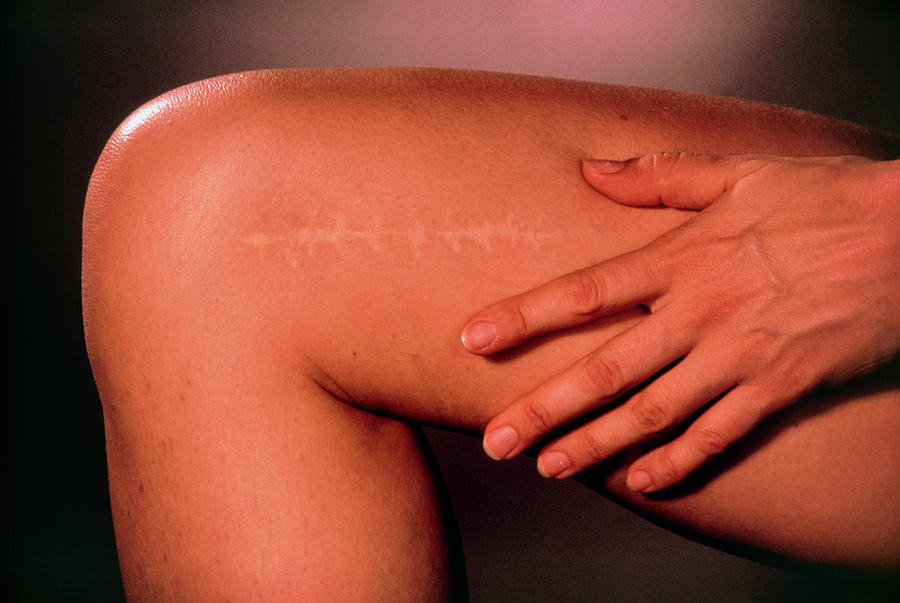 Operation Scar On Womans Leg Photograph by Damien Lovegrove/science Photo Library