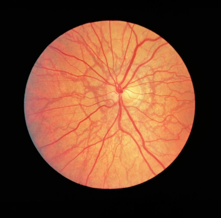 Ophthalmoscope View Of Retina With Angioid Streaks Photograph by Paul Parker/science Photo Library