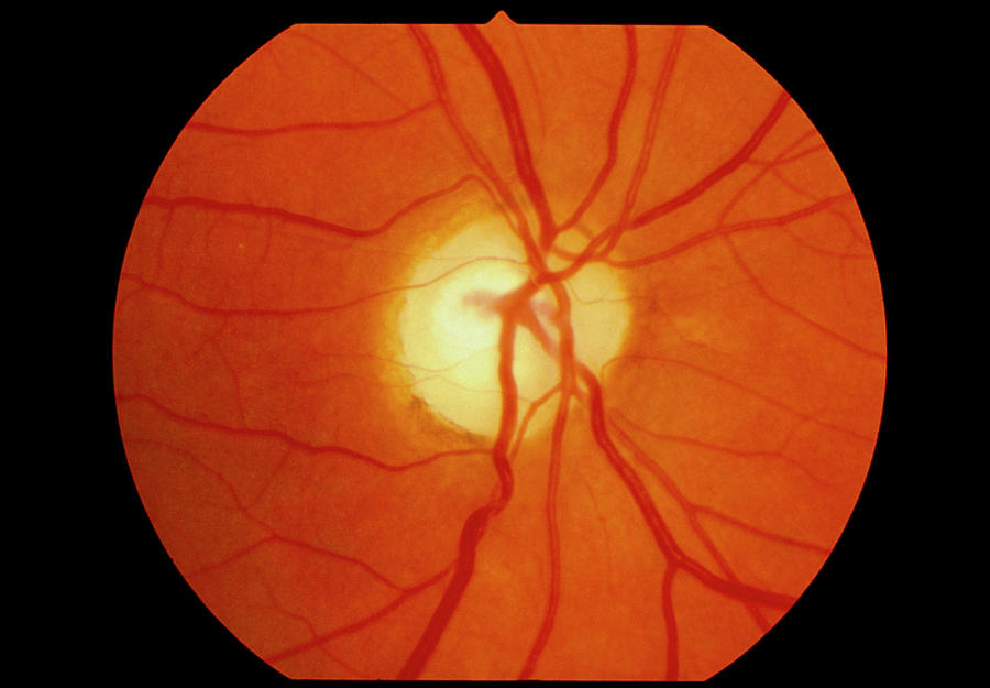 Ophthalmoscope View Of Retina With Optic Atrophy Photograph by Paul Parker/science Photo Library