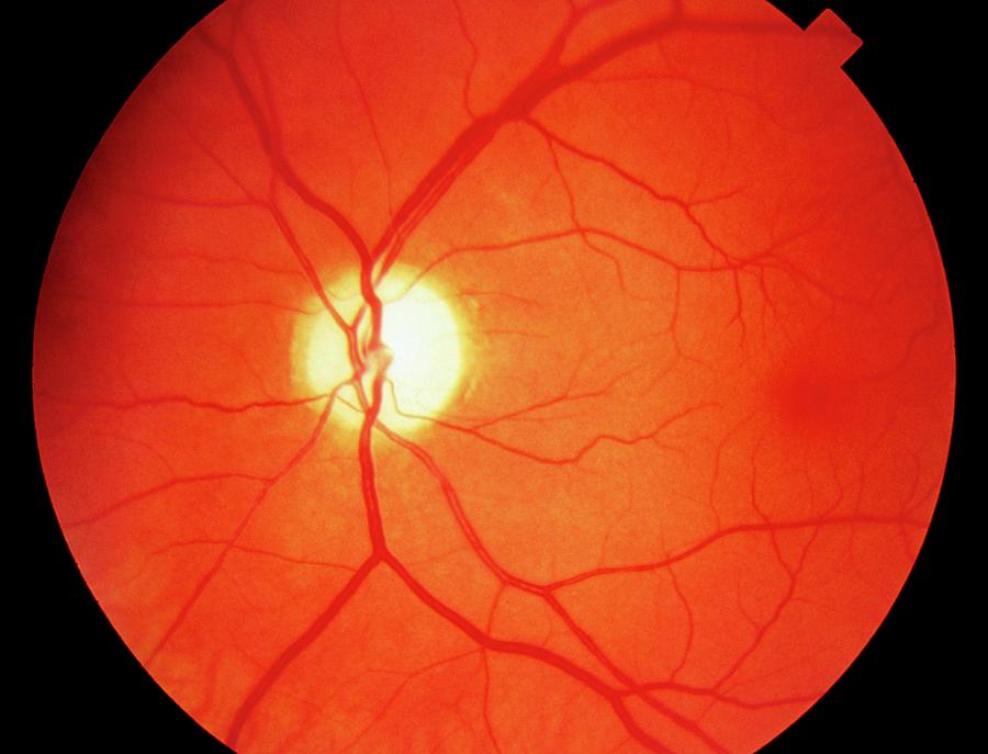 Ophthalmoscope View Of Retina With Optic Atrophy Photograph by Sue Ford/science Photo Library