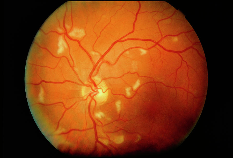 Ophthalmoscopy Of Cmv Retinitis In Aids Patient Photograph by Sue Ford/science Photo Library