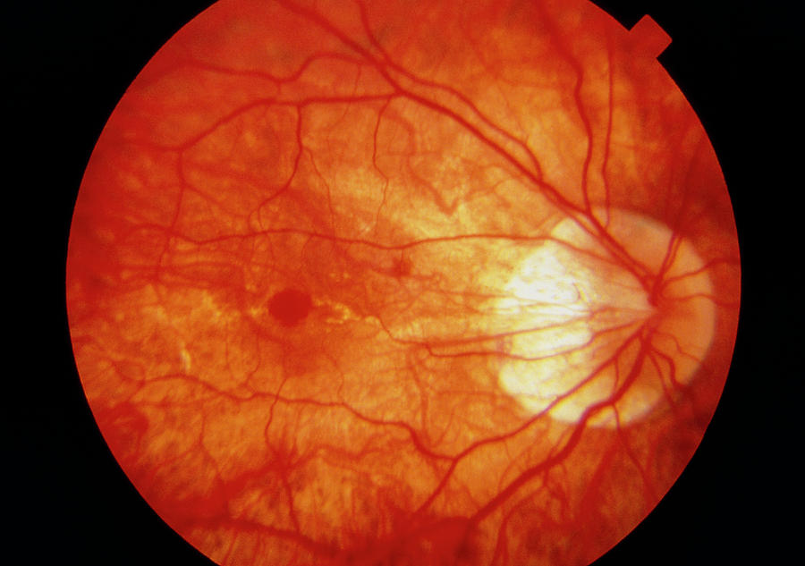 Eye Photograph - Ophthalmoscopy Of Cracked Retina In Myopic Eye by Sue Ford/science Photo Library