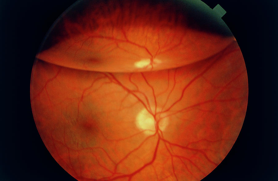 Ophthalmoscopy Of Detached Retina In Patients Eye Photograph by Sue Ford/science Photo Library