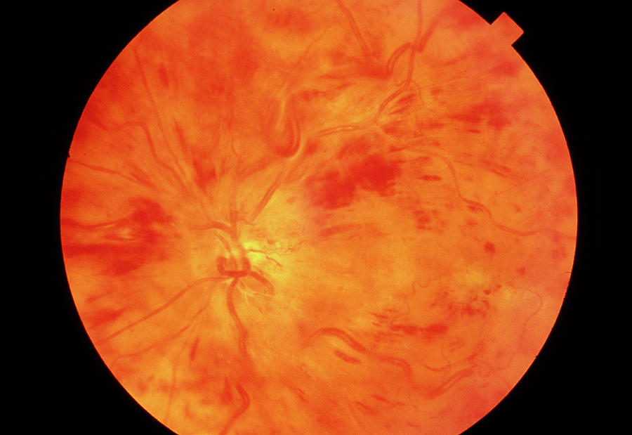 Ophthalmoscopy Of Occluded Central Retinal Vein Photograph by Sue Ford/science Photo Library