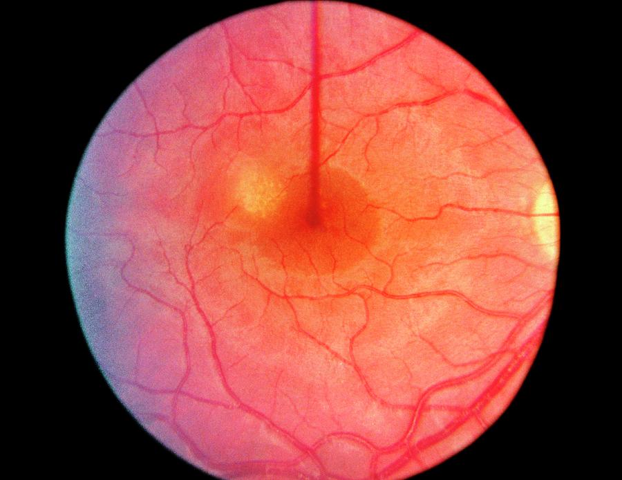Ophthalmoscopy Photograph - Ophthalmoscopy Of Retina Damage By Heroin Abuse by Sue Ford/science Photo Library