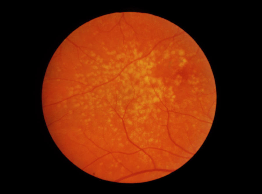 Ophthalmoscopy Of Retina Showing Drusen Photograph by Paul Parker/science Photo Library