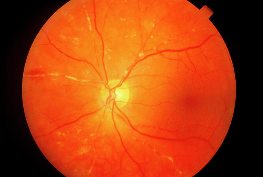 retina image