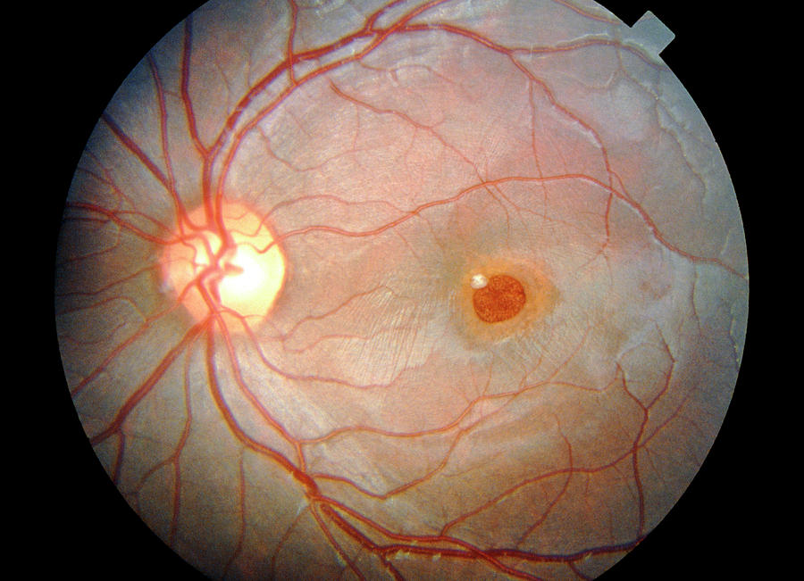Ophthalmoscopy Photograph - Ophthalmoscopy Of Retinopathy Caused By Sunlight by Sue Ford/science Photo Library