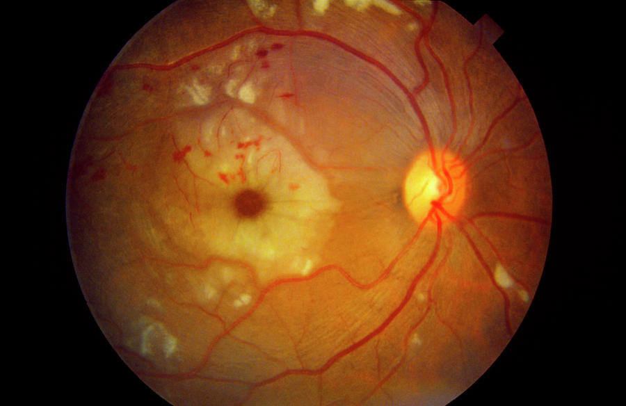 Retina Photograph - Ophthalmoscopy Of Systemic Lupus Erythematosus by Sue Ford/science Photo Library