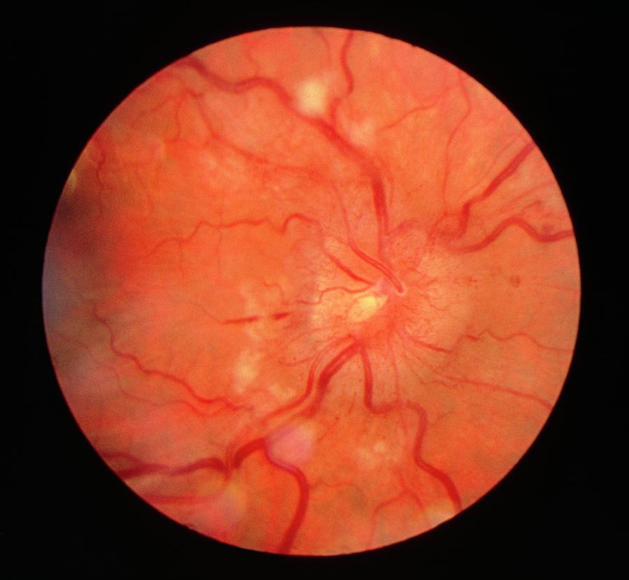 Ophthalmoscopy Of The Retina In Hypertension Photograph by Paul Parker/science Photo Library