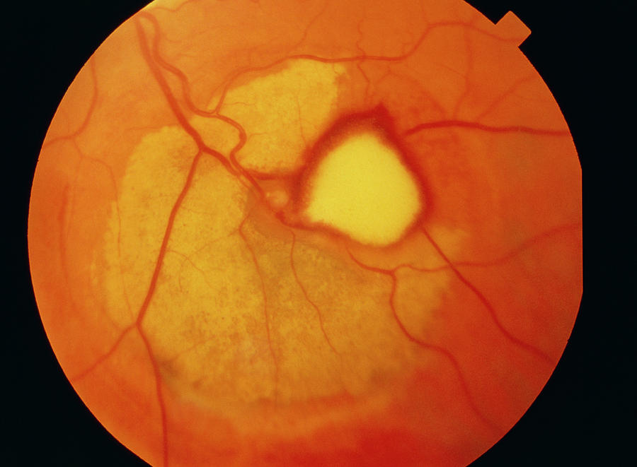 ophthalsmoscopy-of-large-aneurysm-in-retina-of-eye-photograph-by-sue