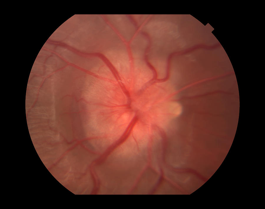 Optic Neuritis With Drusen Photograph by Paul Whitten