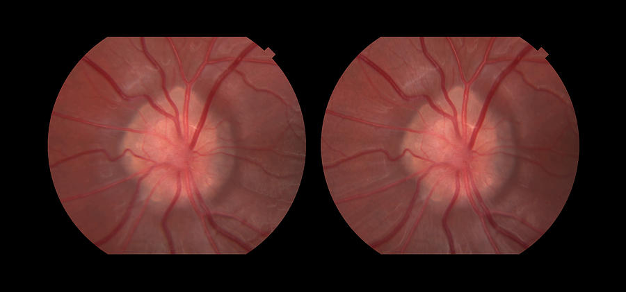 Optic Neuritis With Drusen Stereo Image Photograph by Paul Whitten