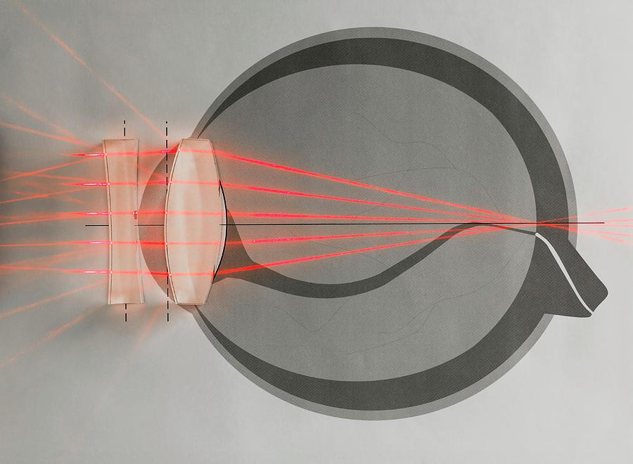 Optics Of Corrected Near-sightedness Photograph by Science Photo Library