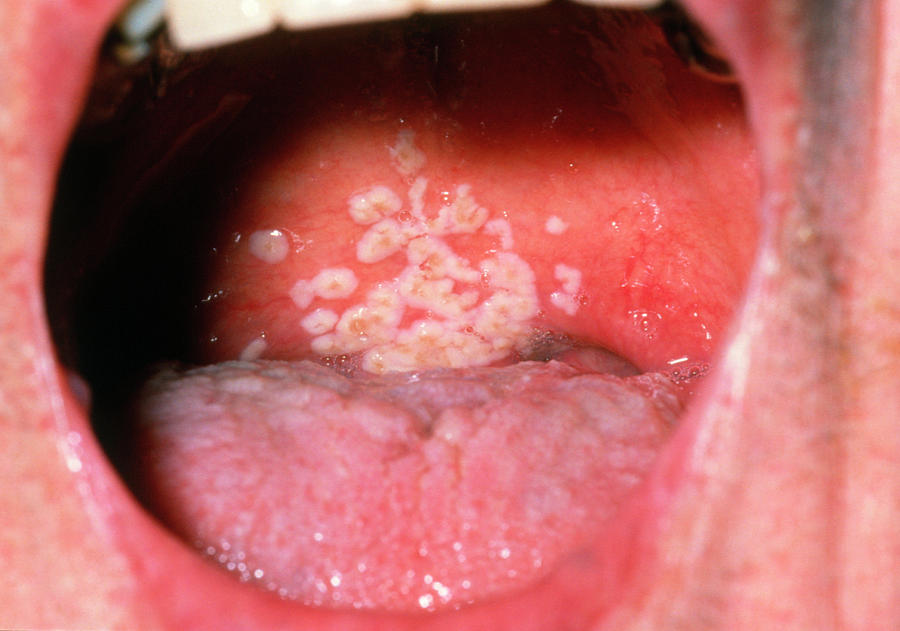 Oral Thrush Candidiasis Photograph By Dr P Marazzi Science Photo Library