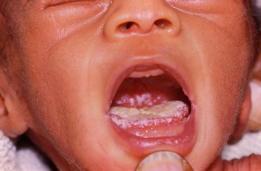 Thrush Photograph - Oral Thrush In Aids Baby by Dr M.a. Ansary/science Photo Library