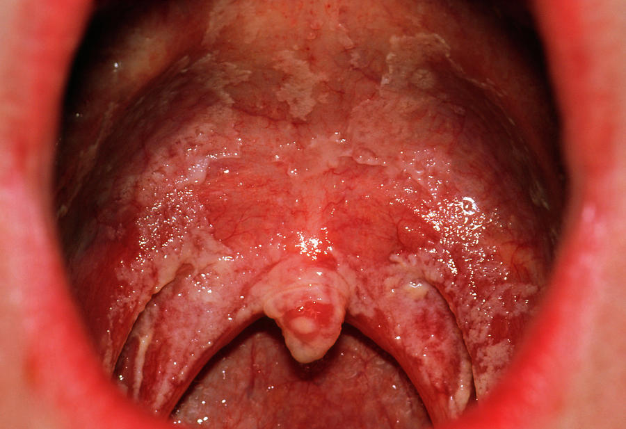 Oral Candidiasis Photograph By Dr P Marazzi Science Photo Library My XXX Hot Girl