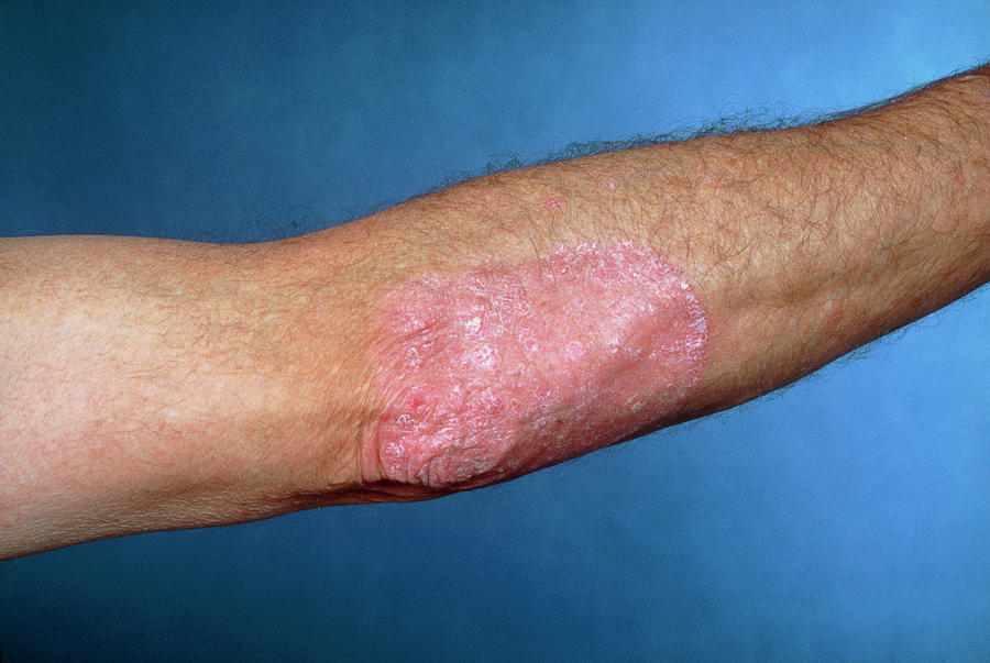 Ordinary Photo Showing Psoriasis On Elbow Photograph By James Stevensonscience Photo Library 