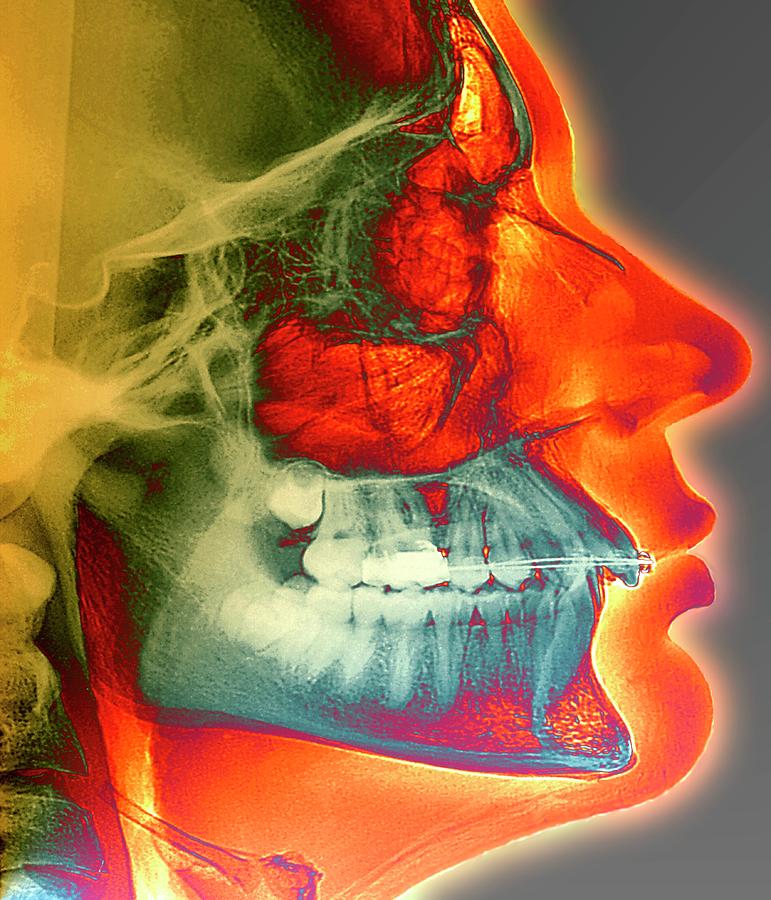 Orthodontic Brace X-ray Photograph by Zephyr/science Photo Library