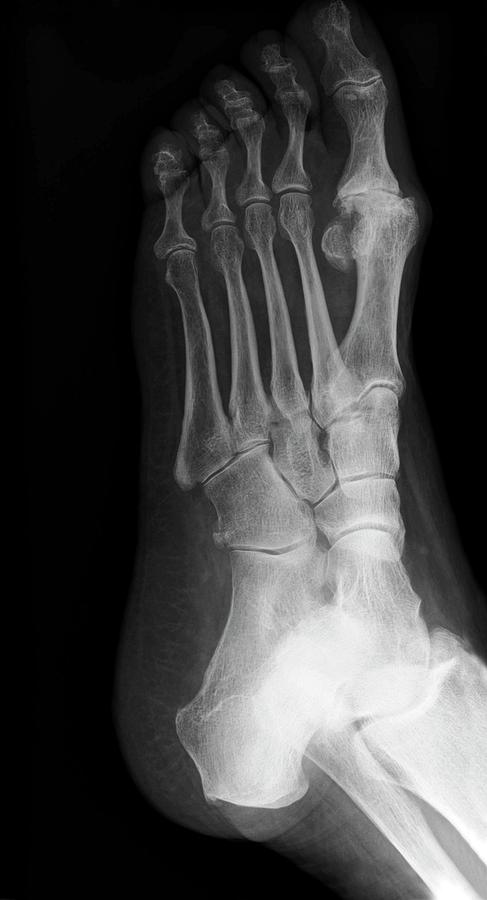 'osteoarthritis In The Big Toe Photograph by Dr P. Marazzi/science ...