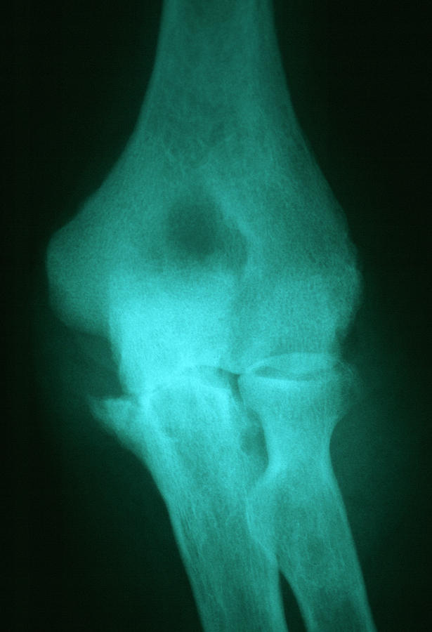 Osteoarthritis Of Elbow Photograph By Dr P. Marazzi/science Photo Library