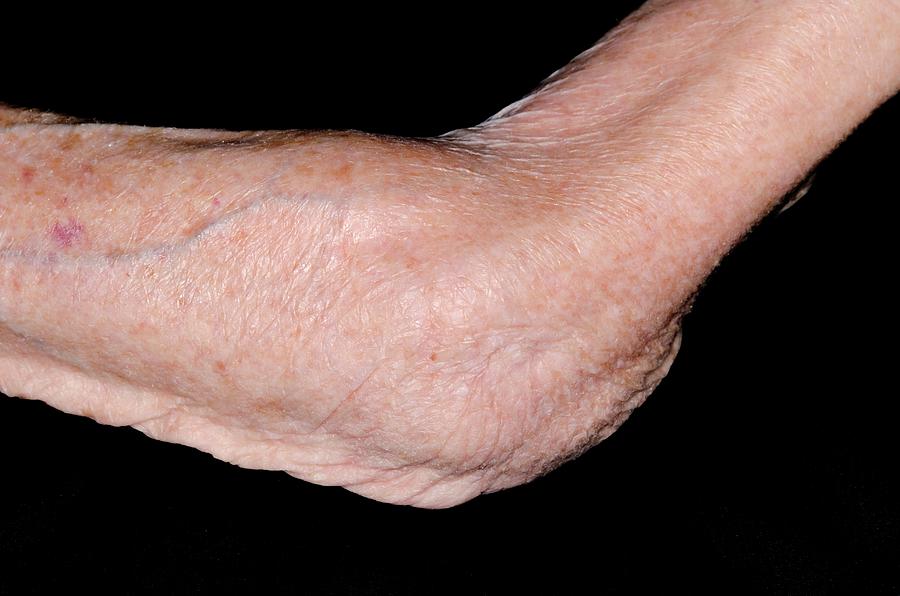 Osteoarthritis Of The Elbow Photograph by Dr P. Marazzi/science Photo ...