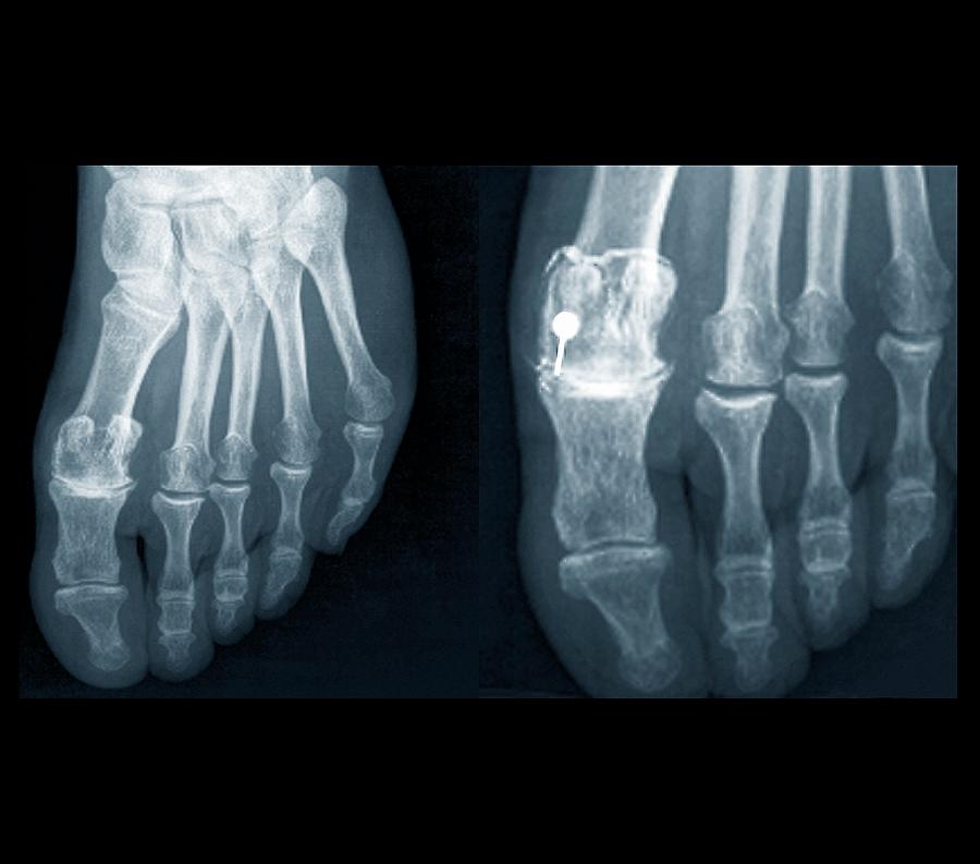 Osteoarthritis Of The Foot Photograph by Zephyr