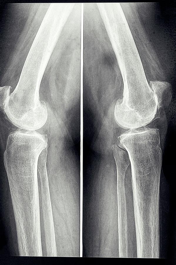 Osteoarthritis Of The Knees Photograph by Brian Gadsby/science Photo Library