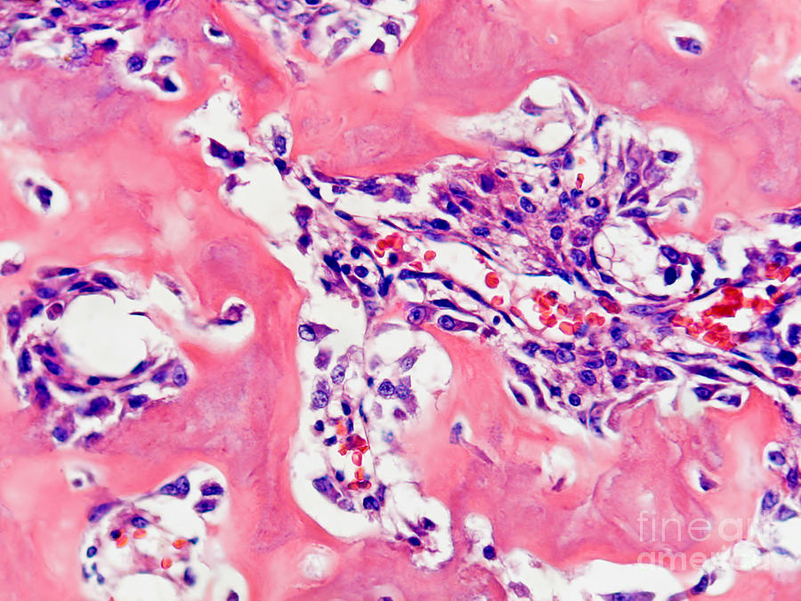Osteogenic Breast Cancer, Lm Photograph by Garry DeLong