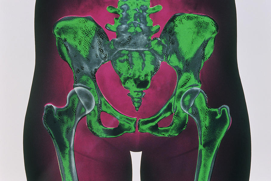 Osteoporosis Of Pelvis Photograph by Chris Bjornberg