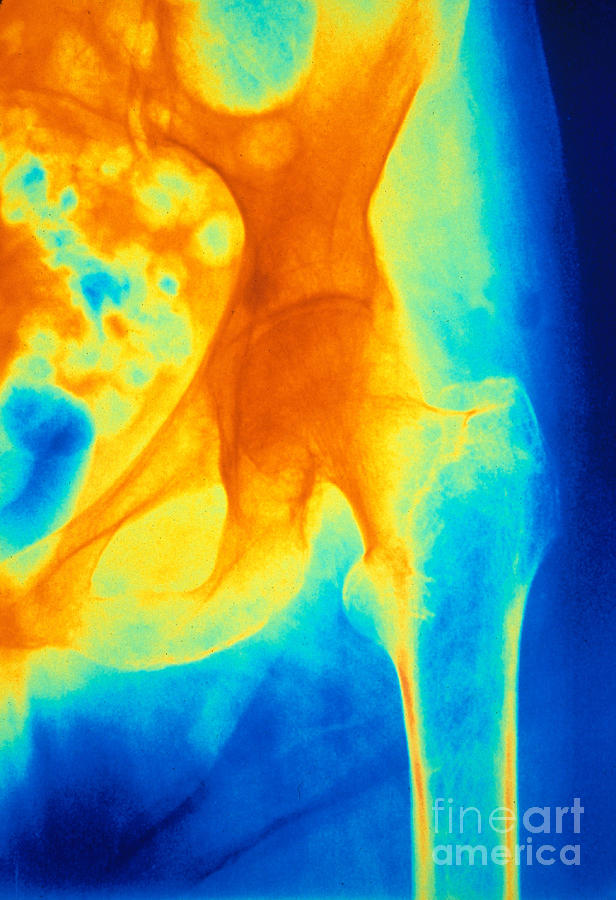 Osteoporosis Of The Hip, X-ray Photograph by Scott Camazine