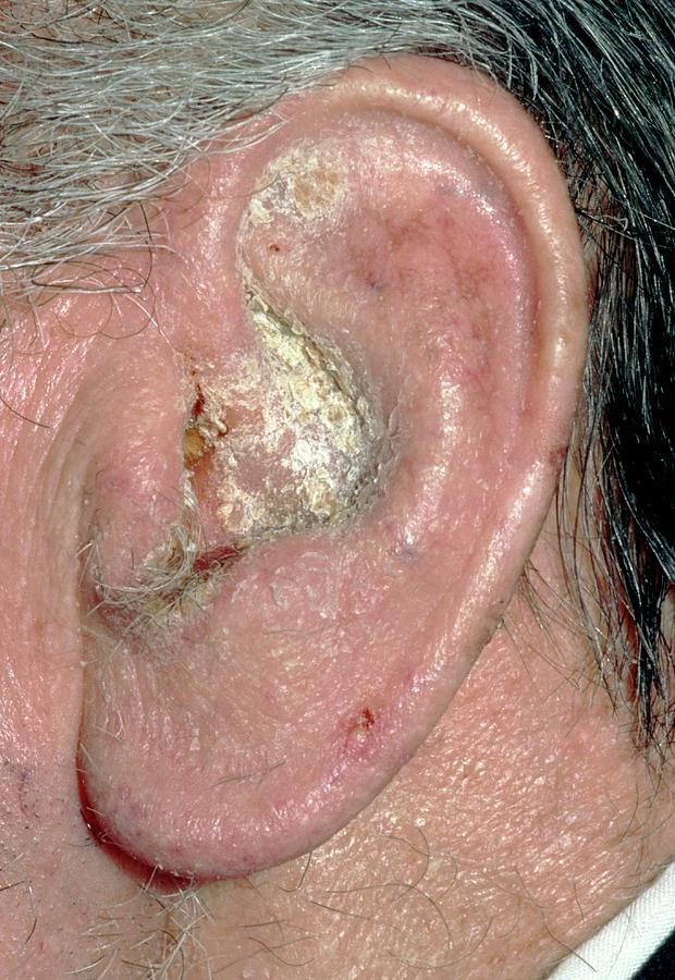 otitis-externa-photograph-by-dr-p-marazzi-science-photo-library