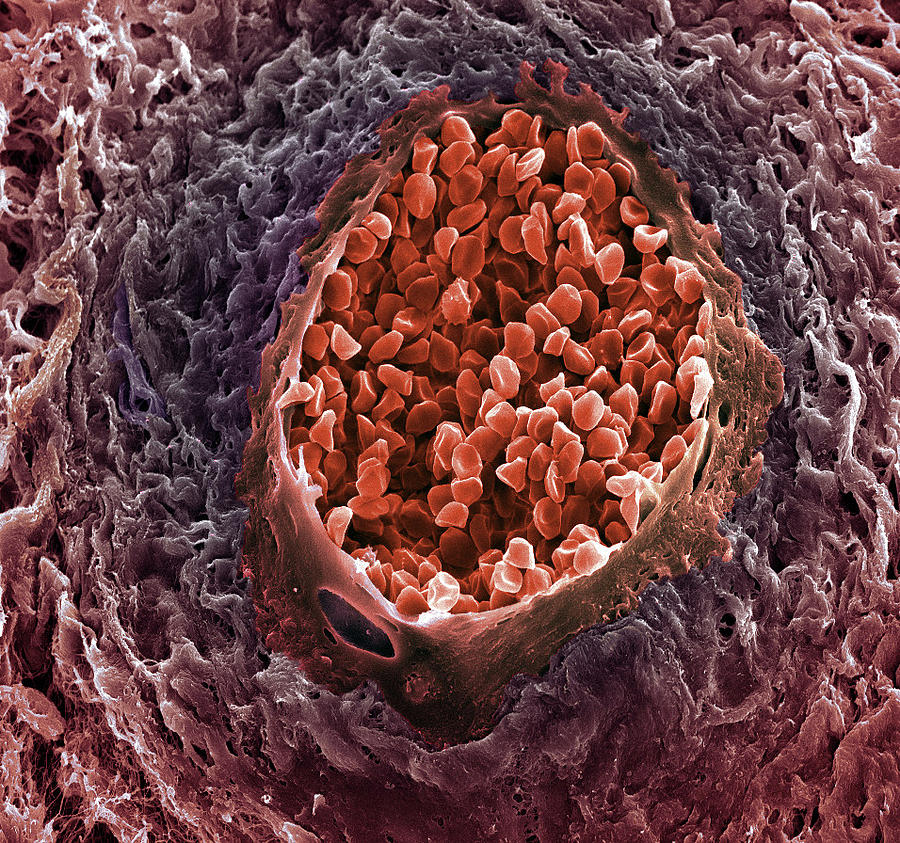 Ovarian Cancer Blood Vessel Photograph by Steve Gschmeissner - Pixels