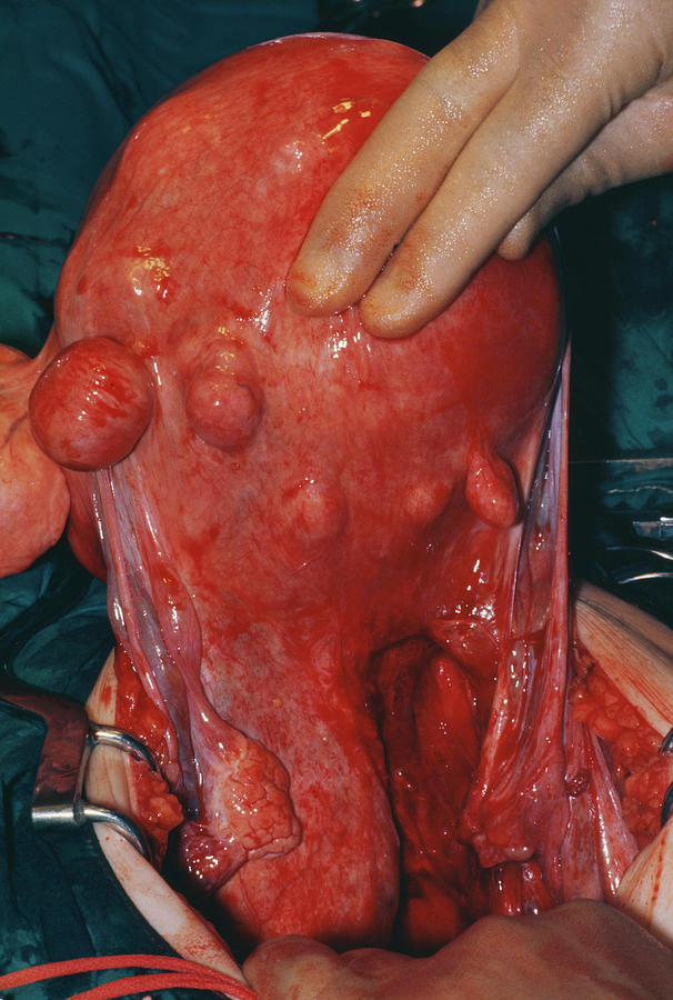 Surgery Photograph - Ovarian Cyst by Steve Allen/science Photo Library