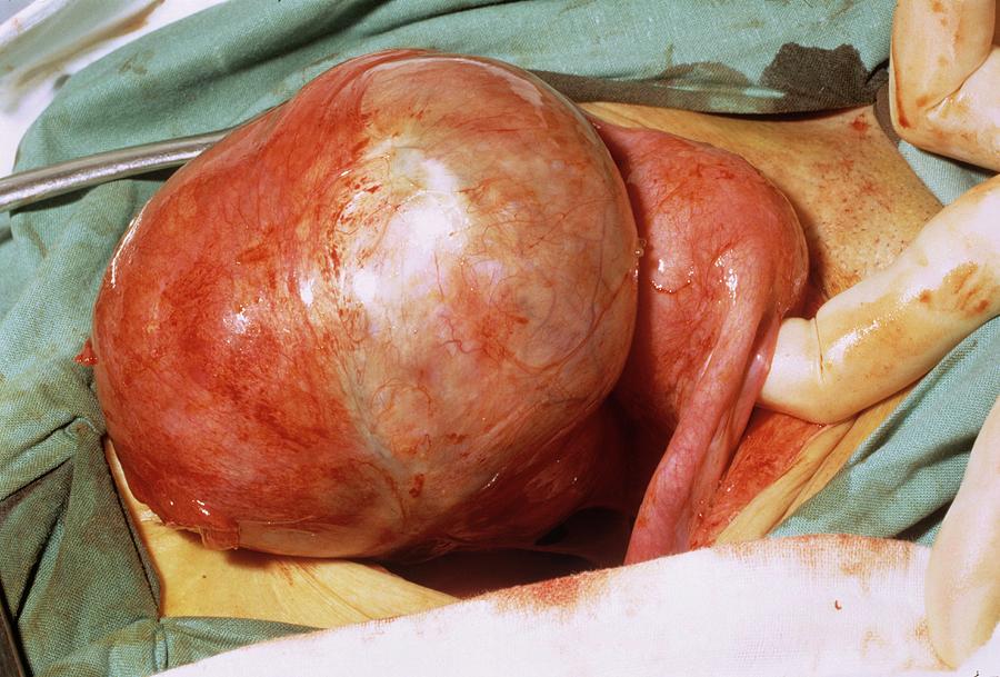 Dermoid Cyst Photograph - Ovarian Cyst Surgical Removal by Dr J. P. Abeille/science Photo Library