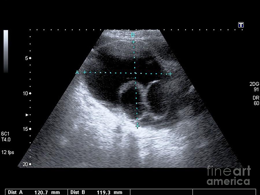 Ovarian Cysts Ultrasound Scan Photograph By Science Photo Library