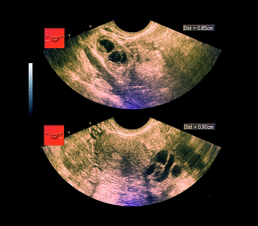 Ovarian Cysts Photograph by Zephyr/science Photo Library - Pixels Merch