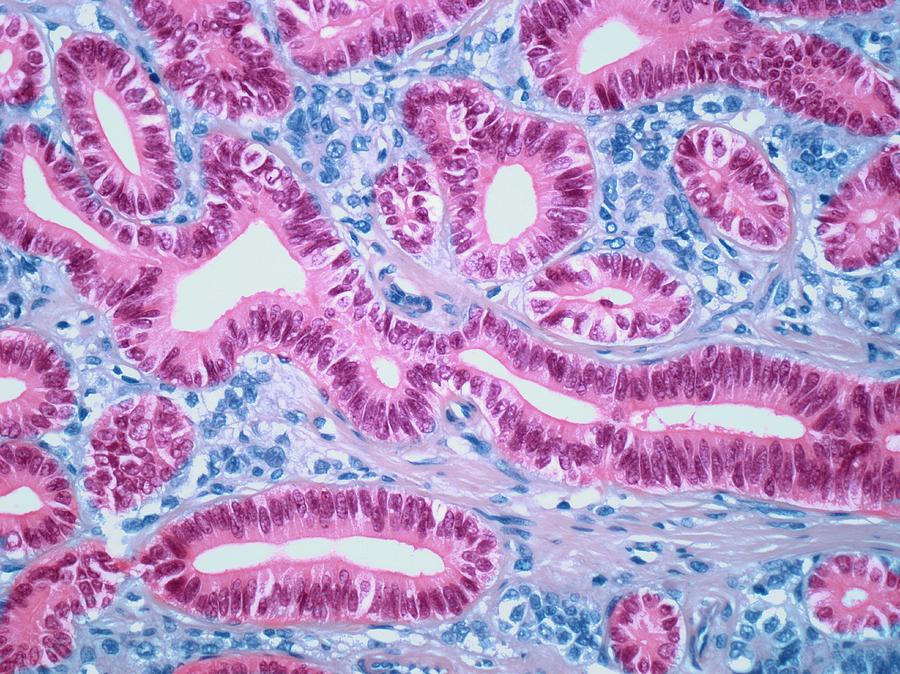 Disease Photograph - Ovarian Sertoli-leydig Tumour by Steve Gschmeissner