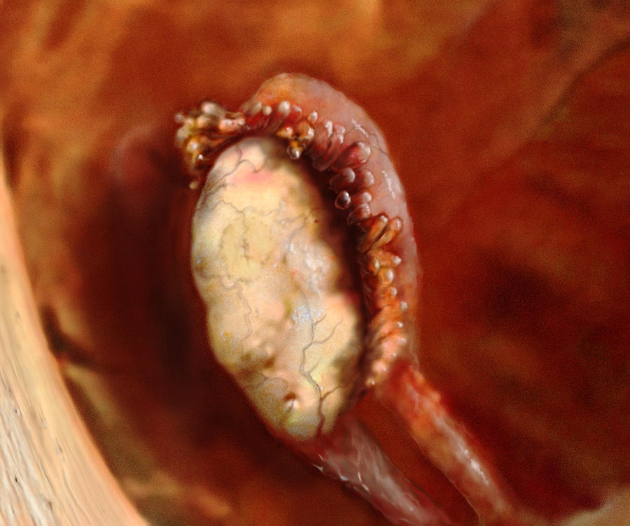 Ovary And Fallopian Tube Photograph by Anatomical Travelogue