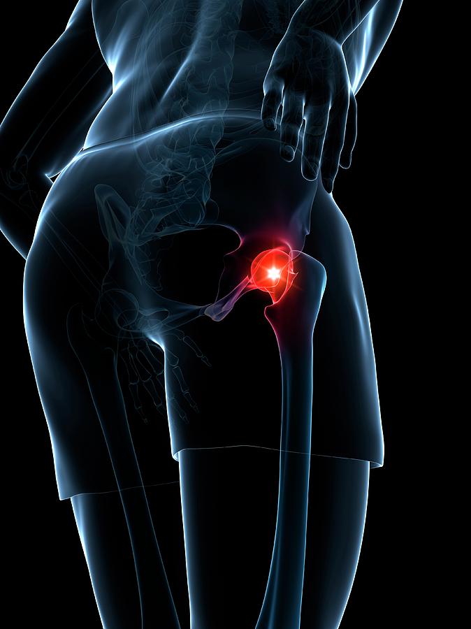 Painful Hip Joint Photograph by Sciepro/science Photo Library