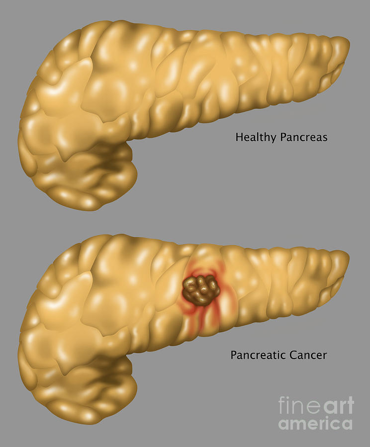 Pancreas, Healthy & Cancerous Photograph by Gwen Shockey