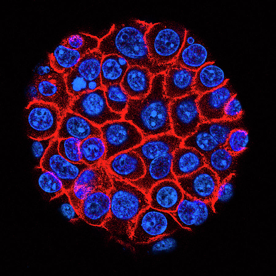 Pancreatic Cancer Cells Photograph by Usc Norris Comprehensive Cancer Center/national Cancer Institute/science Photo Library