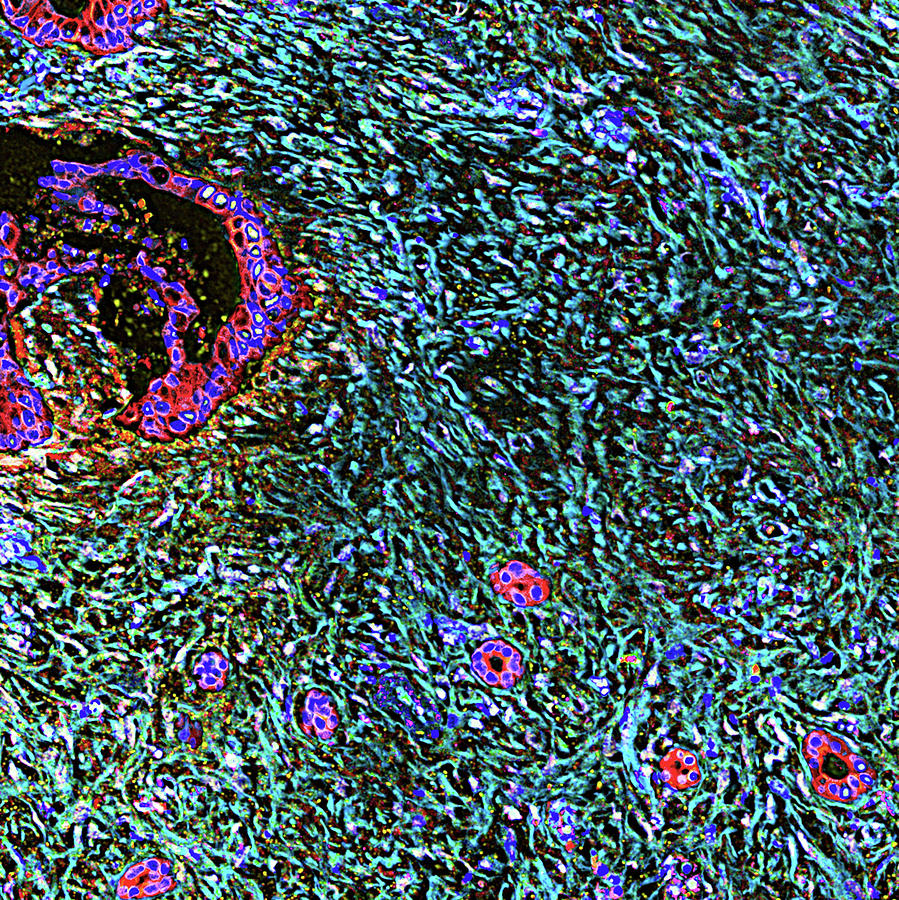 Pancreatic Cancer Desmoplasia Photograph by Fox Chase Cancer Center