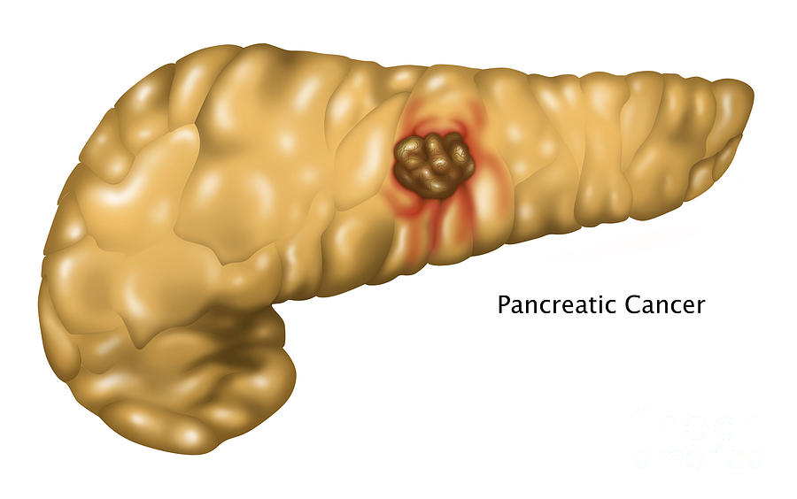 Pancreatic Cancer, Illustration Photograph by Gwen Shockey