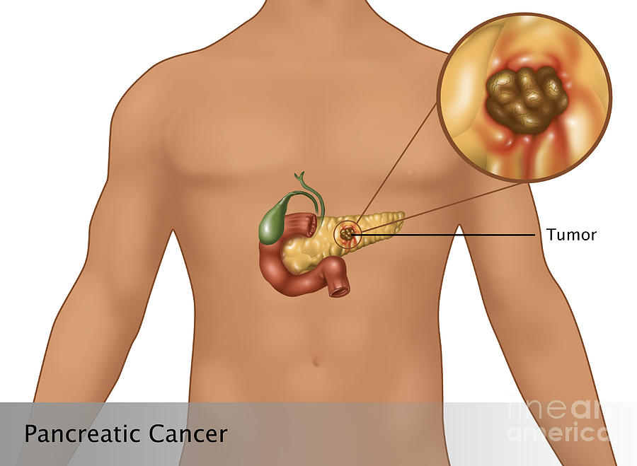 Pancreatic Cancer In Male Figure Photograph by Gwen Shockey